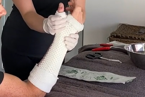Fracture clinic treatment in Bondi Junction Sydney - Physio Fitness